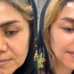 بهترین مرکز لیزر بندرعباس