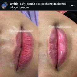 بهترین دکتر تزریق ژل لب بندرعباس