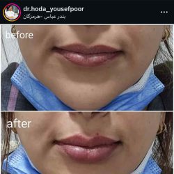 بهترین دکتر تزریق ژل لب بندرعباس
