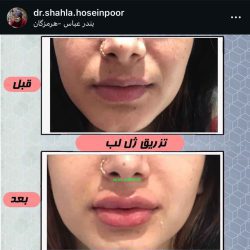 اینستاگرام شهلا حسین پور دکتر تزریق ژل لب بندرعباس
