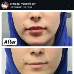 هدا یوسف پور دکتر تزریق ژل لب بندرعباس
