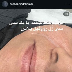 اینستاگرام پاشا نژاد شمسی دکتر تزریق ژل لب بندرعباس