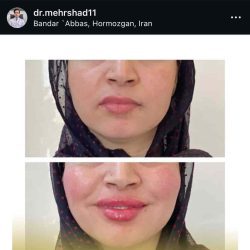 مهرشاد سالار حسینی دکتر تزریق ژل لب بندرعباس
