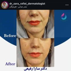 اینستاگرام سارا رفیعی دکتر تزریق ژل بندرعباس