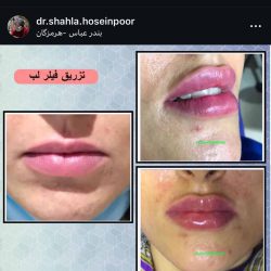 بهترین دکتر تزریق ژل لب بندرعباس