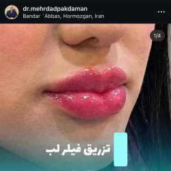 اینستاگرام مهرداد پاکدامن دکتر تزریق ژل لب بندرعباس