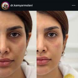 اینستاگرام کامیار مولوی دکتر تزریق ژل لب بندرعباس