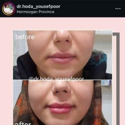 اینستاگرام هدا یوسف پور دکتر تزریق ژل لب بندرعباس