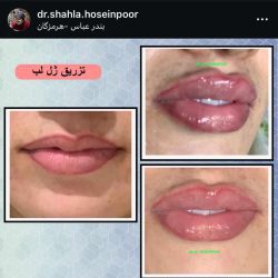 شهلا حسین پور دکتر تزریق ژل لب بندرعباس