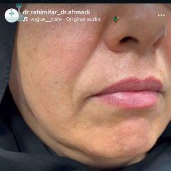 بهترین دکتر تزریق ژل لب بندرعباس