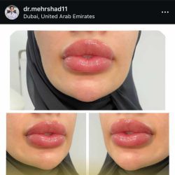 بهترین دکتر تزریق ژل لب بندرعباس