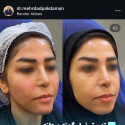 بهترین دکتر تزریق ژل لب بندرعباس