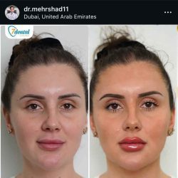 اینستاگرام مهرشاد سالار حسینی دکتر تزریق ژل لب بندرعباس