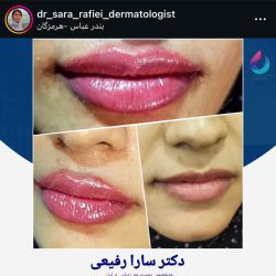 سارا رفیعی دکتر تزریق ژل بندرعباس