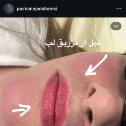 پاشا نژاد شمسی دکتر تزریق ژل لب بندرعباس