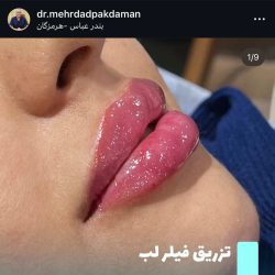 مهرداد پاکدامن دکتر تزریق ژل لب بندرعباس