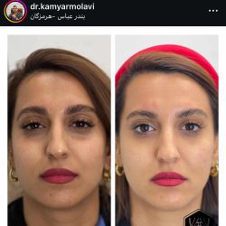 بهترین دکتر تزریق ژل لب بندرعباس