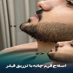 تزریق ژل و فیلر بندرعباس