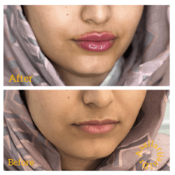 نمونه ی تزریق ژل در بندرعباس - عسل لاریجانی