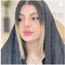 نمونه کار تزریق ژل در بندرعباس - دکتر لاریجانی