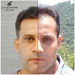 کاشت مو آراد بندرعباس