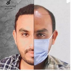 کلینیک کاشت مو آراد بندرعباس
