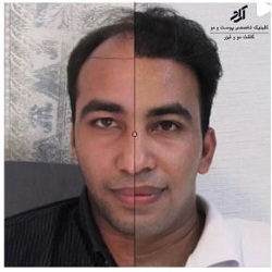 بهترین مرکز کاشت مو بندرعباس