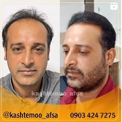 مرکز کاشت مو افسا بندرعباس