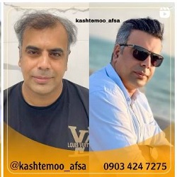 کاشت مو افسا بندرعباس