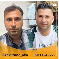 بهترین کلینیک کاشت مو بندرعباس