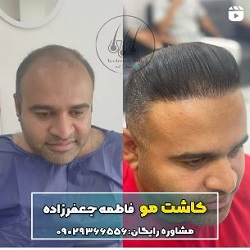 کلینیک کاشت مو جعفر زاده بندرعباس