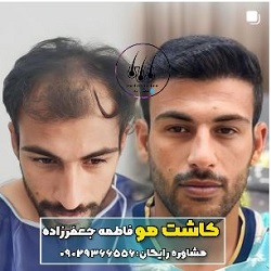 بهترین مرکز کاشت مو بندرعباس