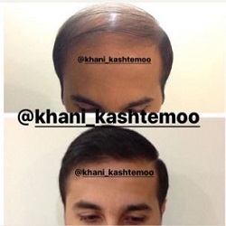 کاشت مو خانی بندرعباس
