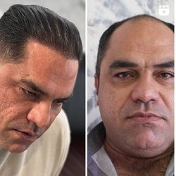 کاشت مو دلربا بندرعباس