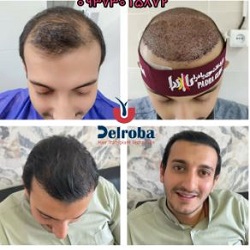 کلینیک کاشت مو دلربا بندرعباس