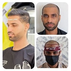 بهترین مرکز کاشت مو بندرعباس