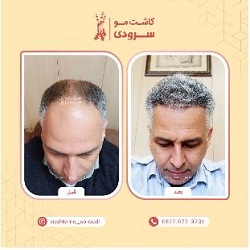 کاشت مو سرودی بندرعباس