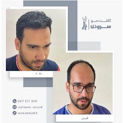 مرکز کاشت مو سرودی بندرعباس