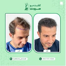 بهترین مرکز کاشت مو بندرعباس