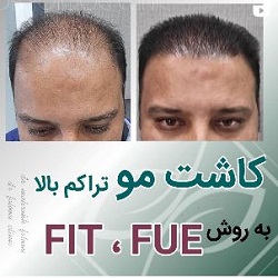 بهترین مرکز کاشت مو بندرعباس