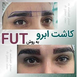 کلینیک کاشت مو فتوئی بندرعباس