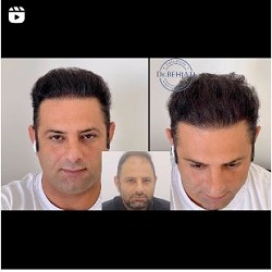 کلینیک کاشت مو بندرعباس