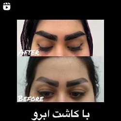 کاشت ابرو پادرا بندرعباس