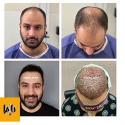 بهترین مرکز کاشت مو بندرعباس