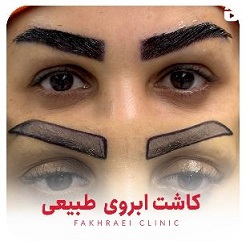 کاشت ابرو پایدار بندرعباس