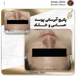 کلینیک پاکسازی لونا | بهترین مرکز پاکسازی پوست بندرعباس