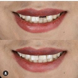 متخصص ایمپلنت بندرعباس