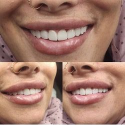 دکتر فاضل اکبری ایمپلنت بندرعباس
