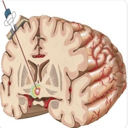 بهترین دکتر مغز و اعصاب بندرعباس_دکتر سلطانی