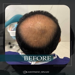 کلینیک سینایی کاشت مو_بندرعباس